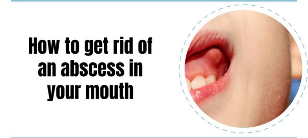 mouth abscess treatment