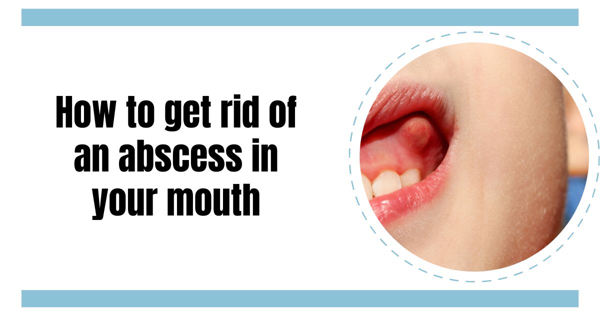 How to get rid of an abscess in your&nbsp;mouth